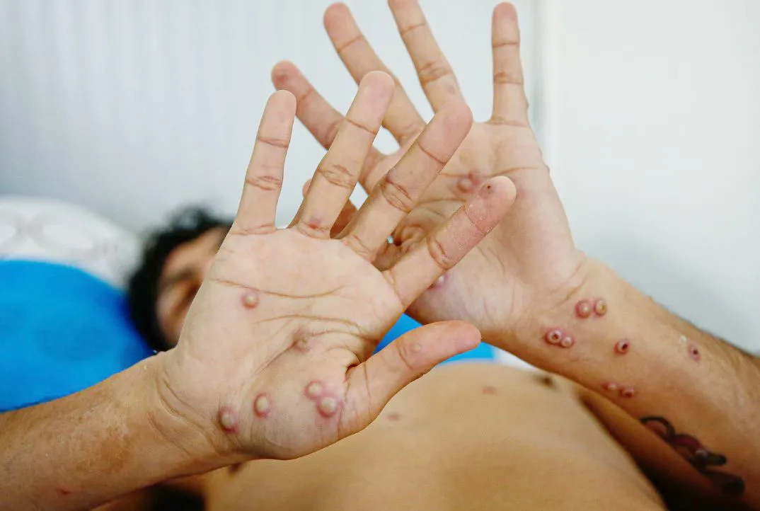 NOTA 2 VIRUELA DEL MONO